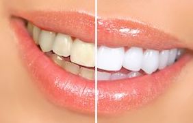 blanqueamiento-dental-en-barcelona-dientes-blancos-antes-y-despues-arsuaga