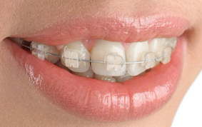 brackets-esteticos-ortodoncia-barcelona brackets-esteticos-ortodoncia-barcelona