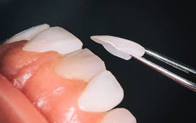 carillas-dentales-en-barcelona-clinica-lopez-arsuaga