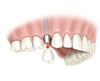 implante-dental-unitario implante-dental-unitario