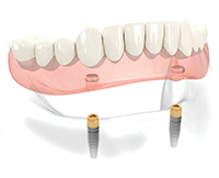 implante-protesis-removible implante-protesis-removible