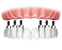 protesis-de-ceramica-sobre-implantes protesis-de-ceramica-sobre-implantes