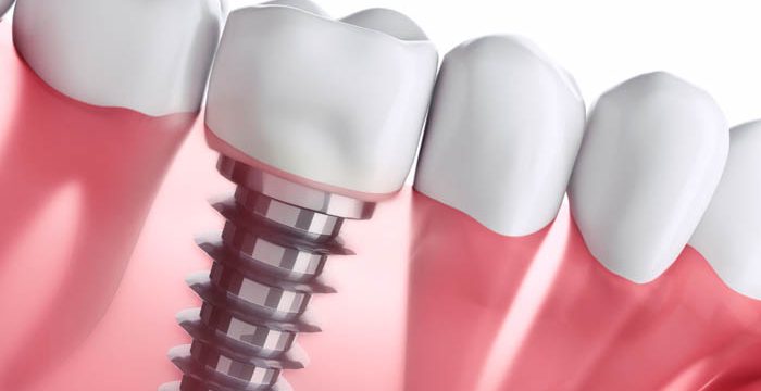 "implantes-dentales-dudas"/