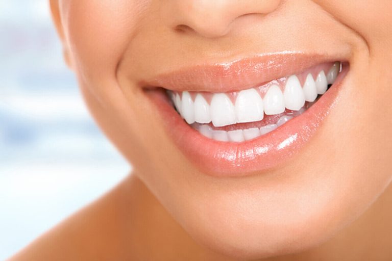 "carillas-dentales-barcelona"/