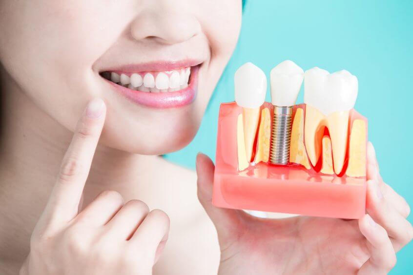 como-cuidar-los-implantes-dentales