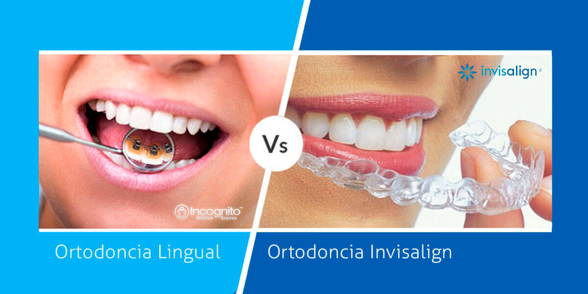 ortodoncia-lingual-o-invisalign ortodoncia-lingual-o-invisalign