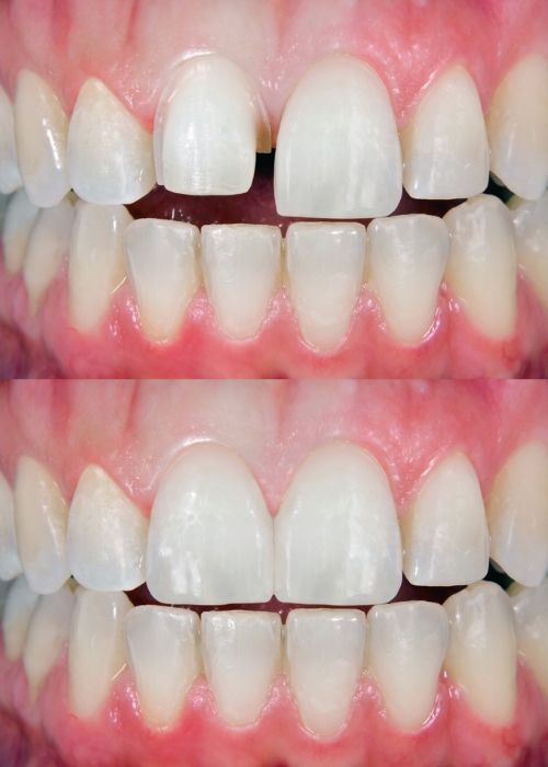 Carillas dentales Sarrià-Sant Gervasi López Arsuaga