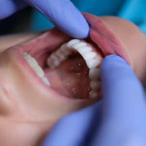 Carillas dentales Sarrià-Sant Gervasi